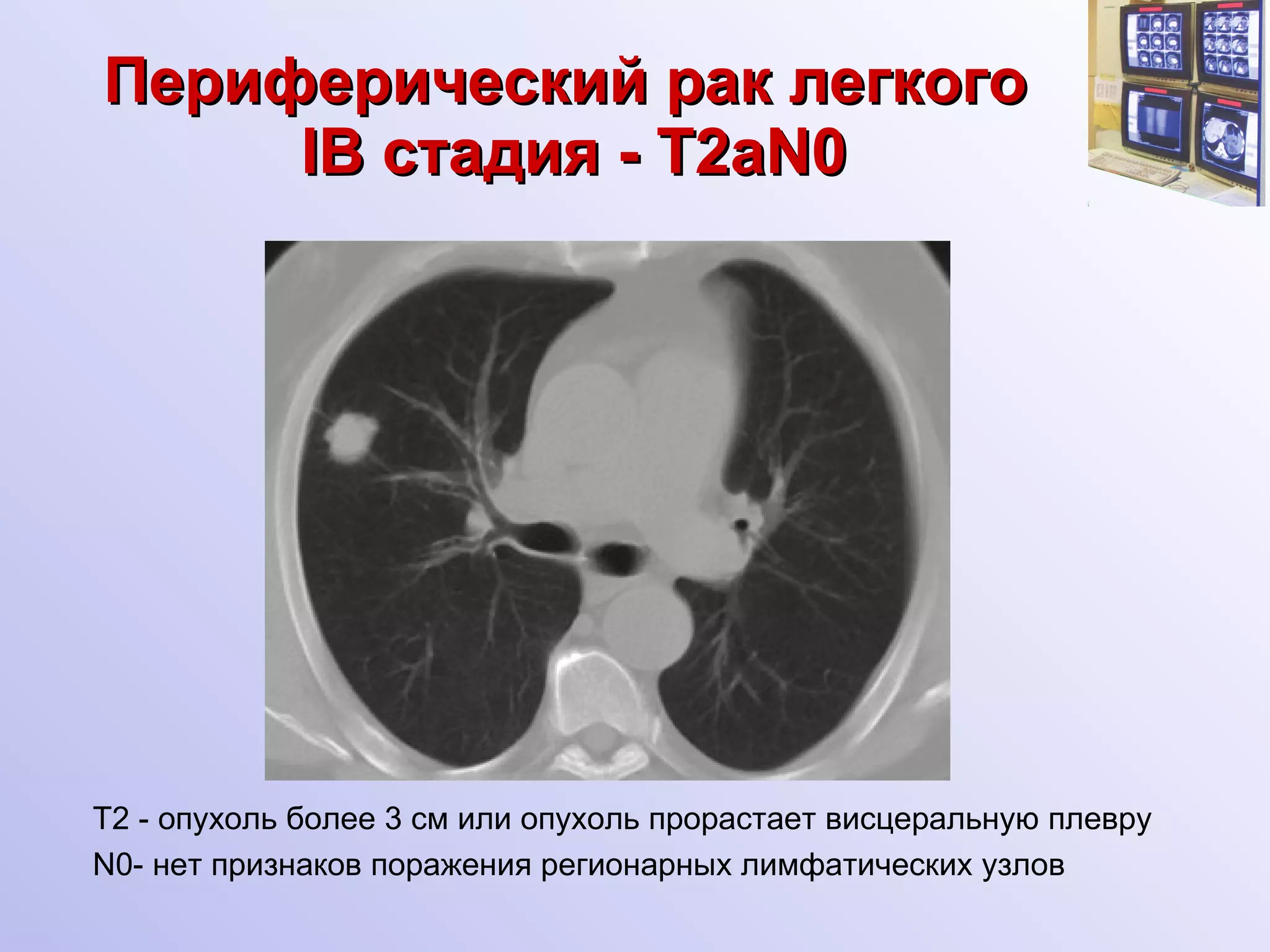Периферический рак легкого   I В  c тадия   - Т 2aN0 Т2 - опухоль более 3 см или опухоль прорастает висцеральную плевру N0- нет признаков поражения регионарных лимфатических узлов 