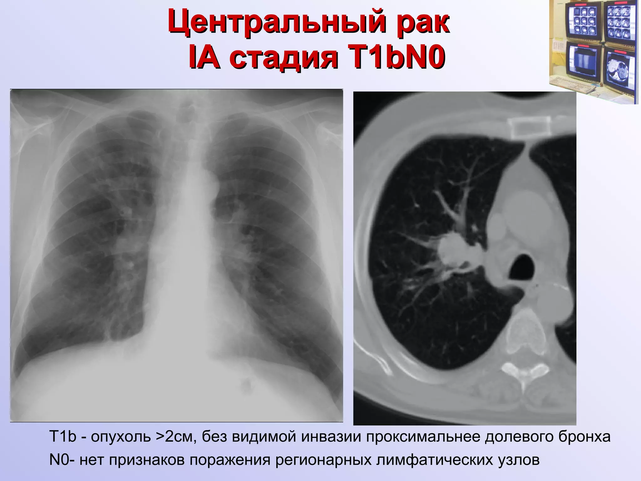 Центральный рак    I А  c тадия  T1bN0 Т1 b  - опухоль  >2 см, без видимой инвазии проксимальнее долевого бронха N0- нет признаков поражения регионарных лимфатических узлов 