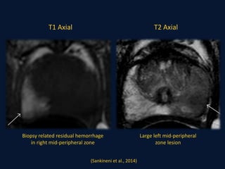 T1 Axial T2 Axial
Biopsy related residual hemorrhage
in right mid-peripheral zone
Large left mid-peripheral
zone lesion
(Sankineni et al., 2014)
 