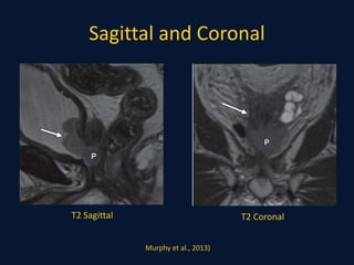 Sagittal and Coronal
T2 Sagittal T2 Coronal
Murphy et al., 2013)
 