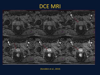 DCE MRI
(Korobkin et al., 2014)
 