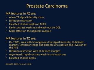 Prostate Carcinoma
MR features in PZ are:
• A low T2 signal intensity mass
• Diffusion restriction
• Elevated choline peaks on MRSI
• Early contrast wash-in and wash-out on DCE.
• Mass effect on the adjacent capsule
MR features in TZ are:
• On T2WI, area with homogenous low signal intensity, ill-defined
margins, lenticular shape and absence of a capsule and invasion of
the AFS
• Diffusion restriction with ill-defined margins
• Asymmetric rapid contrast wash-in and wash out
• Elevated choline peaks
(PI-RADS, 2015; Yu et al, 2014)
 