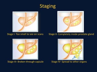 Staging
Stage I- Too small to see on scans Stage II- Completely inside prostate gland
Stage III- Broken through capsule Stage IV- Spread to other organs
 