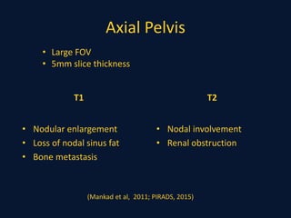 Axial Pelvis
T1
• Nodular enlargement
• Loss of nodal sinus fat
• Bone metastasis
T2
• Nodal involvement
• Renal obstruction
• Large FOV
• 5mm slice thickness
(Mankad et al, 2011; PIRADS, 2015)
 