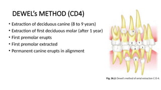 720936236-serial-extractions_for_dental_students.pptx