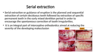 720936236-serial-extractions_for_dental_students.pptx