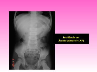Incidência em
Ântero-posterior (AP)
 