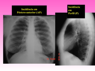 Incidência
    Incidência em       em
Póstero-anterior (AP)   Perfil (P)
 