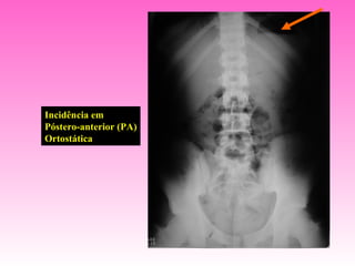 Incidência em
Póstero-anterior (PA)
Ortostática
 