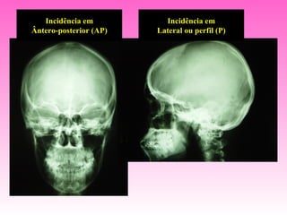Incidência em          Incidência em
Ântero-posterior (AP)   Lateral ou perfil (P)
 