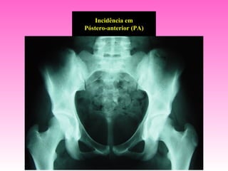 Incidência em
Póstero-anterior (PA)
 