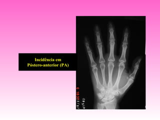 Incidência em
Póstero-anterior (PA)
 