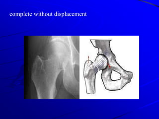 - Mechanism : - Minimal trauma in old people with                                                                                                                                                                osteoporosis- High energy trauma in young adults .