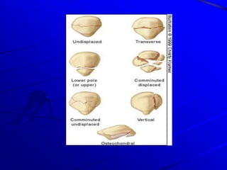 Direct Mechanism- a fall on patella, heavy object falling across the knee Inspection- knee joint is extremely swollen, in slightly flexed position Palpation-   effusion in the knee joint is easily                     determined 
