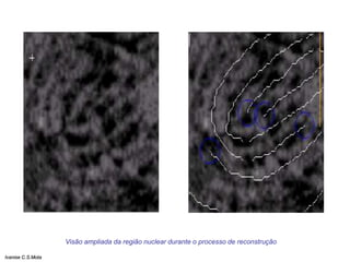 Visão ampliada da região nuclear durante o processo de reconstrução
Ivanise C.S.Mota
 