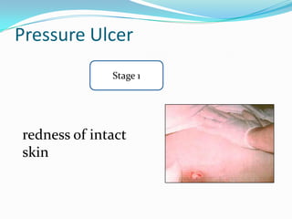 Pressure Ulcer
              Stage 1




redness of intact
skin
 