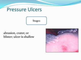 Pressure Ulcers
                       Stage2



abrasion, crater, or
blister; ulcer is shallow
 