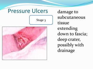 Pressure Ulcers     damage to
          Stage 3
                    subcutaneous
                    tissue
                    extending
                    down to fascia;
                    deep crater,
                    possibly with
                    drainage
 