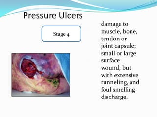 Pressure Ulcers
                  damage to
       Stage 4    muscle, bone,
                  tendon or
                  joint capsule;
                  small or large
                  surface
                  wound, but
                  with extensive
                  tunneling, and
                  foul smelling
                  discharge.
 