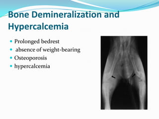 Bone Demineralization and
Hypercalcemia
 Prolonged bedrest
 absence of weight-bearing
 Osteoporosis
 hypercalcemia
 