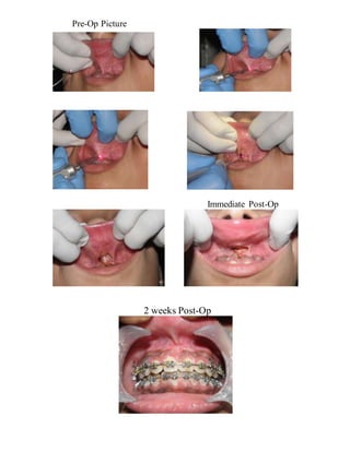 Pre-Op Picture
Immediate Post-Op
2 weeks Post-Op