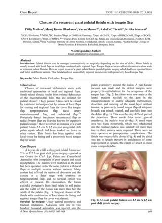 Case Report DOI: 10.18231/2393-9834.2018.003
J Dent Specialities. 2018;6(2):166-168 166
Closure of a recurrent giant palatal fistula with tongue flap
Philip Mathew1
, Manoj Kumar Bhaskaran2
, Varun Menon P3
, Rahul VC Tiwari4,*
, Kritika Sehrawat5
1
HOD, 2
Professor, 3,4
MDS, 5
PG Student 1
Dept. of OMFS & Dentistry, 2
Dept. of OMFS, 3
Dept. of FIBCSOMS, 4
Dept. of FOGS,
OMFS & Dentistry, 5
Dept. of OMFS, 1,3,4
Charles Pinto Centre for Cleft lip, Palate and Craniofacial Anomalies, JMMCH & RI,
Thrissur, Kerala, 2
Sree Anjenaya Institute of Dental Science, Modakallur, Atholi, Calicut, Kerala, 5
Sudha Rustagi College of
Dental Sciences & Research, Faridabad, Haryana, India
*Corresponding Author:
Email: drrahulvctiwari@gmail.com
Abstract
Introduction: Palatal fistulas can be managed conservatively or surgically depending on the size of defect. Giant fistula is
usually treated with local flaps or local flaps combined with regional flaps. Tongue flaps are an excellent alternative to close wide
or recurrent palatal fistulae. Here we report a case of a giant palatal fistula postcleft palate surgery which had been operated thrice
and failed in different centers. This fistula has been successfully repaired in our center with posteriorly based tongue flap.
Keywords: Palatal fistula, Cleft palate, Tongue flap.
Introduction
Closure of intra-oral deformities starts with
traditional approaches or local and regional flaps.
Small palatal fistula results from twisted dehiscence
of the mucoperiosteal folds that are utilized for
palatal closure.1
Huge palatal fistula can't be closed
by traditional techniques but by means of local flaps
for coating and regional flaps for cover like tongue
flap, temporoparietal flap, facial artery
musculomucosal flap, and submental flap.2-6
Posteriorly based buccinator myomucosal flap or
radial forearm flap are likewise known for expansive
palatal closure.7
Here we report an instance of a giant
palatal fistula 2.5 cm X 2.5 cm post congenital cleft
palate repair which had been worked on thrice in
other centers. This fistula has been repaired with
local tissue for lining and a posteriorly based tongue
flap for cover.
Case Report
A 4-year old child with a giant palatal fistula size
2.5 cm X 2.5 cm post cleft palate surgery reported to
our Centre for Cleft Lip, Palate and Craniofacial
Anomalies with complaint of poor speech and nasal
regurgitation. The parents were mortified as the child
had been operated on for the same problem with local
flaps at multiple centers without success. Many
centers had offered the option of obturators and the
closure at a later stage with temporal or
temporoparietal flaps and no surgical option was
offered at present. On examination, the fistula
extended posteriorly from hard palate to soft palate
and the width of the fistula was more than half the
width of the palate (Fig. 1). Surgical closure of the
fistula with combination of local tissue for lining and
regional tongue flap for cover was planned.
Surgical Technique: Under general anesthesia and
tracheal intubation, Xylocaine with one in two
hundred thousand adrenaline was injected into the
palate extensively around the lesion. A peri-fistular
incision was made and the defect margins were
properly de-epithelialized for the acceptance of the
tongue flap. (Fig. 2) Incisions were now made at the
lateral margins parallel to the gum in the
mucoperiosteum to enable adequate mobilization,
dissection and suturing of the nasal layer without
tension. A posteriorly based tongue flap of adequate
breadth was raised, rotated, and carefully inset into
the defect (Fig. 3). This was the only difficult part of
the procedure. Three weeks later under general
anesthesia, the pedicle was divided. A small open
area was found posteriorly, which was refashioned
and the residual pedicle was sutured; not more than
two or three sutures were required. There were no
intra operative or postoperative complications. The
fistula was successfully closed (Fig. 4) and the child
was put to speech therapy in anticipation of some
improvement of speech, the extent of which in most
cases is unpredictable.
Fig. 1: A Giant palatal fistula size 2.5 cm X 2.5 cm
post cleft palate surgery
 