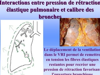 Interactions entre pression de r
Interactions entre pression de ré
étraction
traction
é
élastique pulmonaire et calibre des
lastique pulmonaire et calibre des
bronches
bronches
• .
Le déplacement de la ventilation
dans le VRI permet de remettre
en tension les fibres élastiques
restantes pour recréer une
pression de rétraction favorisant
l’ouverture bronchique
 