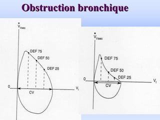 Obstruction bronchique
Obstruction bronchique
 