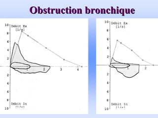 Obstruction bronchique
Obstruction bronchique
 