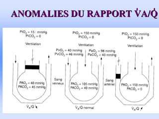 ANOMALIES DU RAPPORT VA/Q
ANOMALIES DU RAPPORT VA/Q
 