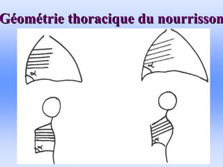 G
Gé
éom
omé
étrie thoracique du nourrisson
trie thoracique du nourrisson
 