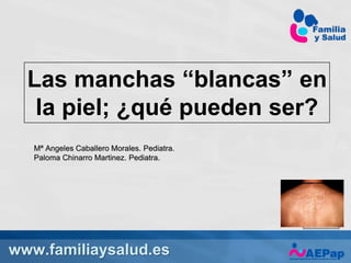 www.familiaysalud.es
Las manchas “blancas” en
la piel; ¿qué pueden ser?
Mª Angeles Caballero Morales. Pediatra.
Paloma Chinarro Martinez. Pediatra.
Imagen
(la añadimos
nosotros)
 