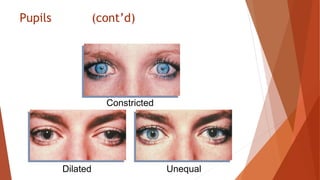 Pupils (cont’d)
Constricted
Dilated Unequal
 