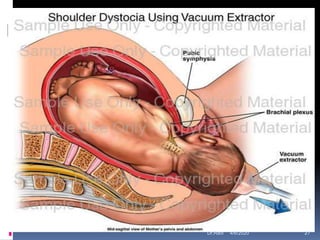 Plexopathies
4/6/2020 27Dr.Ravi
 