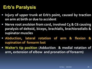  Injury of upper trunk at Erb’s point, caused by traction
on arm at birth or due to accident
 Nerve root avulsion from cord, involved C5 & C6 causing
paralysis of deltoid, biceps, brachialis, brachioradialis &
supinator muscles
 Abduction, lateral rotation of arm & flexion &
supination of forearm lost
 Waiter’s tip position (Adduction & medial rotation of
arm, extension of elbow and pronation of forearm)
Erb’s Paralysis
4/6/2020 28Dr.Ravi
 