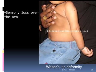 Sensory loss over
the arm
Waiter’s tip deformity
4/6/2020 29Dr.Ravi
 