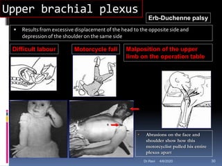 Upper brachial plexus
 Results from excessive displacement of the head to the opposite side and
depression of the shoulder on the same side
Difficult labour Motorcycle fall
Erb-Duchenne palsy
• Abrasions on the face and
shoulder show how this
motorcyclist pulled his entire
plexus apart
Malposition of the upper
limb on the operation table
4/6/2020 30Dr.Ravi
 