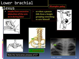 Lower brachial
plexus
 results from excessive
abduction of the arm
as in during labor
Klumpke palsy
• or when a person
falls from a height
grasping something
to save himself
Note the transverse process of C7
• Cervical rib
4/6/2020 34Dr.Ravi
 