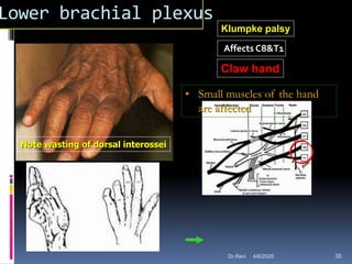 Lower brachial plexus
Affects C8&T1
Claw hand
• Small muscles of the hand
are affected
Klumpke palsy
Note wasting of dorsal interossei
4/6/2020 35Dr.Ravi
 