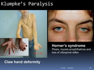 Klumpke’s Paralysis
Claw hand deformity
Horner’s syndrome
Ptosis, myosis,enophthalmos and
loss of ciliospinal reflex
4/6/2020 36Dr.Ravi
 