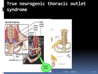 True neurogenic thoracic outlet
syndrome
4/6/2020 44Dr.Ravi
 