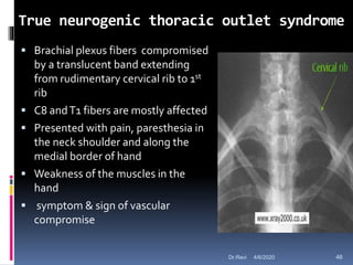 True neurogenic thoracic outlet syndrome
 Brachial plexus fibers compromised
by a translucent band extending
from rudimentary cervical rib to 1st
rib
 C8 andT1 fibers are mostly affected
 Presented with pain, paresthesia in
the neck shoulder and along the
medial border of hand
 Weakness of the muscles in the
hand
 symptom & sign of vascular
compromise
4/6/2020 46Dr.Ravi
 