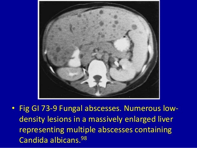 73 focal decreased attenuation masses in the liver