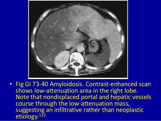 73 focal decreased attenuation masses in the liver
