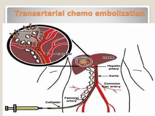 Transarterial chemo embolization
 