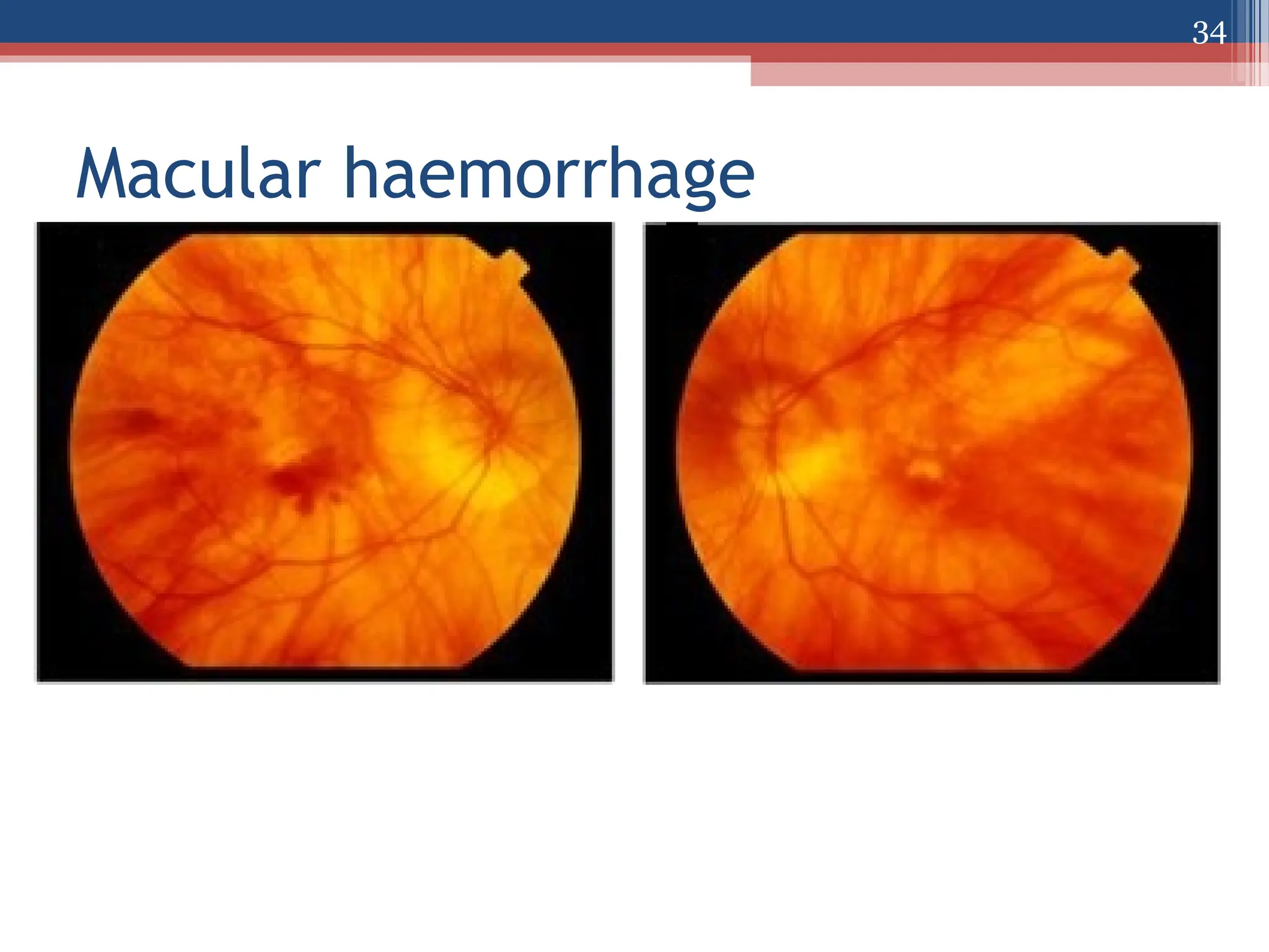 Macular haemorrhage
34
 