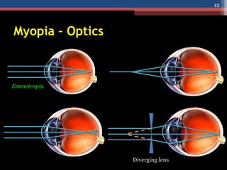 Myopia – Optics
Diverging lens
Emmetropia
12
 