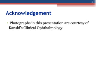 Acknowledgement
• Photographs in this presentation are courtesy of
Kanski’s Clinical Ophthalmology.
2
 