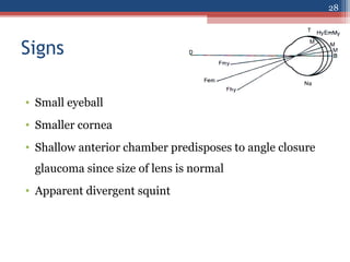 Signs
• Small eyeball
• Smaller cornea
• Shallow anterior chamber predisposes to angle closure
glaucoma since size of lens is normal
• Apparent divergent squint
28
 