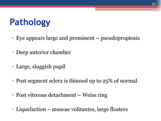 Pathology
• Eye appears large and prominent – pseudoproptosis
• Deep anterior chamber
• Large, sluggish pupil
• Post segment sclera is thinned up to 25% of normal
• Post vitreous detachment – Weiss ring
• Liquefaction – muscae volitantes, large floaters
31
 